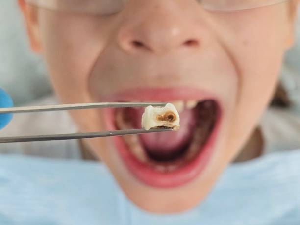Best Emergency Dental Care for Broken or Chipped Teeth in Harlem, GA